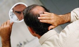 Primary hair fall reasons in Man’s